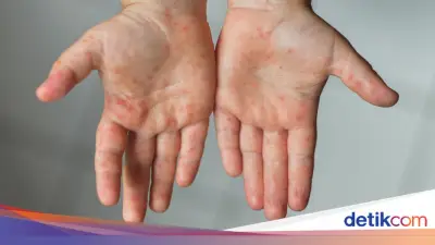 Dinkes Banten Temukan 2.000 Suspek Campak hingga Maret 2026, Waspadai Potensi KLB