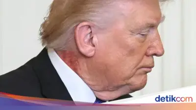 Ruam Merah di Leher Trump di Gedung Putih Picu Spekulasi Kesehatan