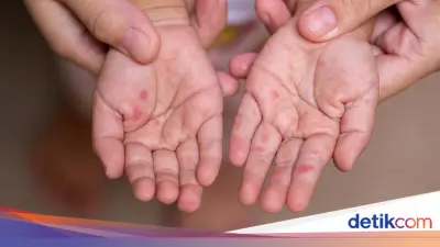 Dinkes Banten: Masih Ada Orang Tua Tolak Vaksin Campak untuk Anak