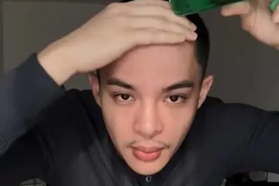 Rey Mbayang Cukur Botak karena Autoimun Psoriasis, Bukan Gaya