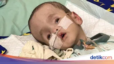 Anugerah Bayi 6 Bulan Hidrosefalus Berjuang Sembuh, Butuh Donasi